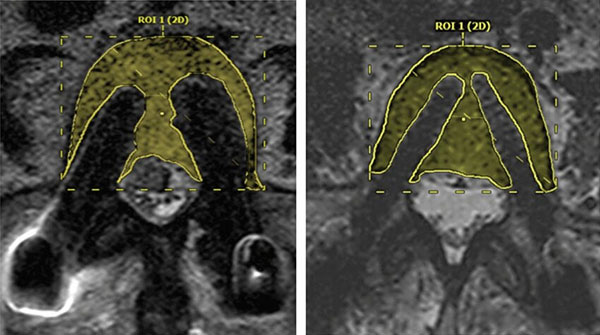 Carbon Fiber Spine Instrumentation in Irvine: Metal-Free Options in Spine Surgery