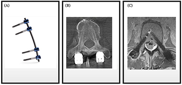 Carbon Fiber Spine Instrumentation in Irvine: Metal-Free Options in Spine Surgery